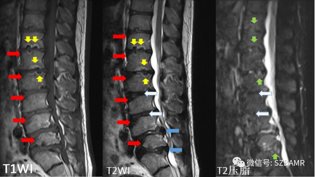 mr腰椎冠状位 轴位 t2wi