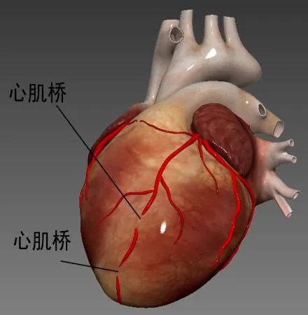 图5 心肌桥示意图 作者介绍