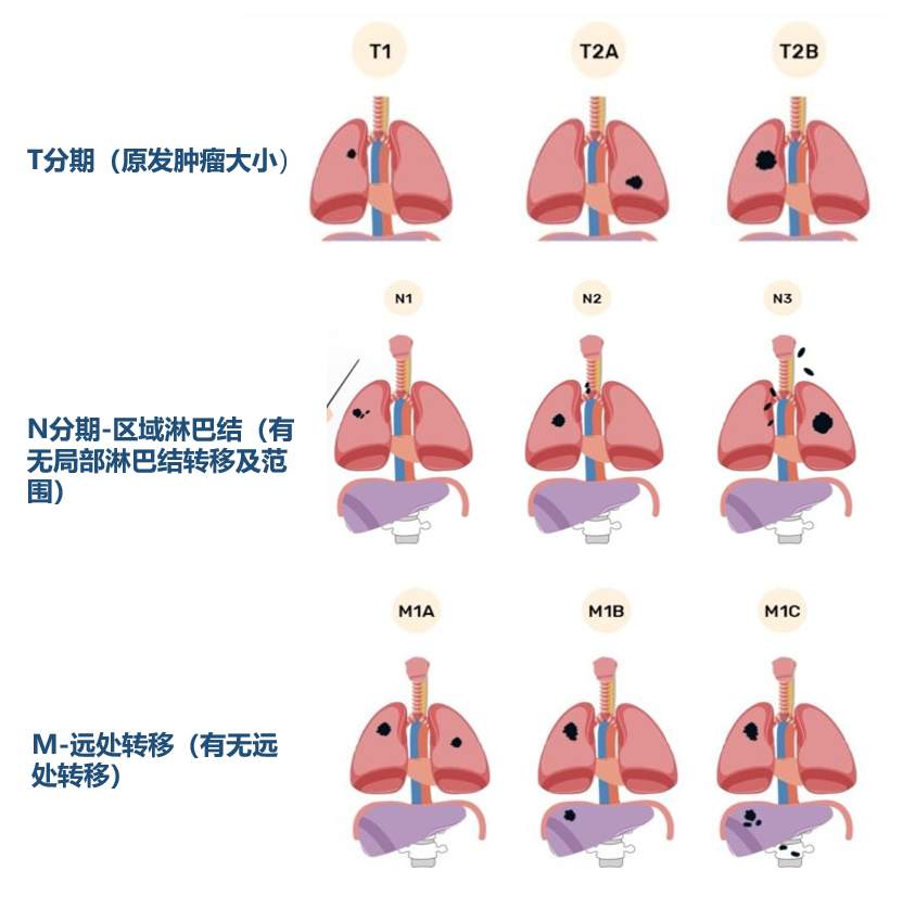 肺癌为什么需要基因检测