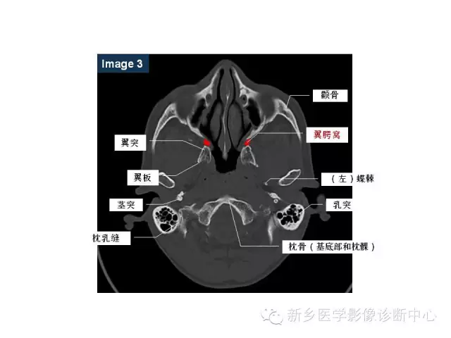 颅底详细断层解剖