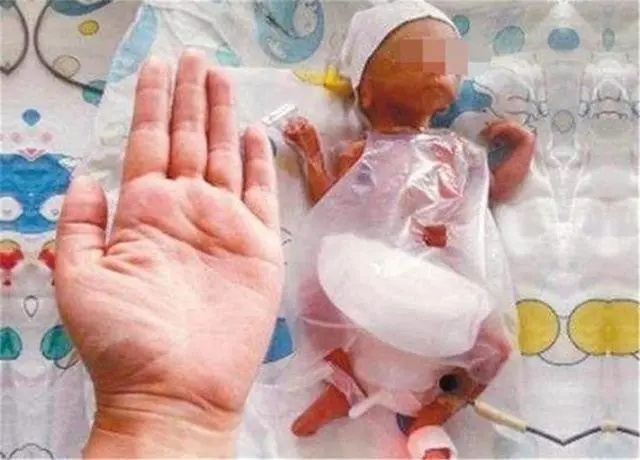 这个广西宝宝出生才1斤2两,一个手掌大,救治97天