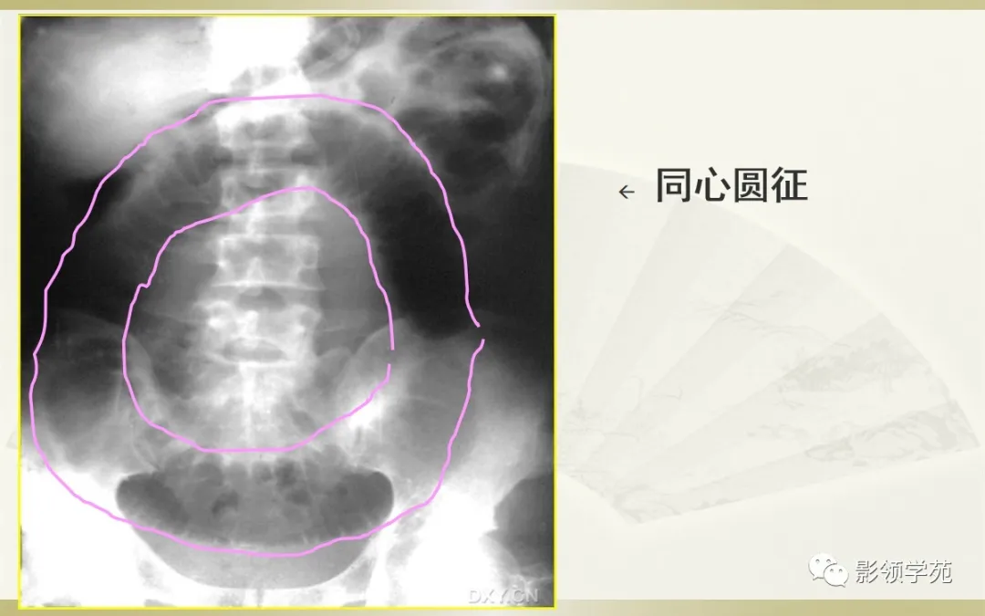 肠梗阻的分类及影像表现