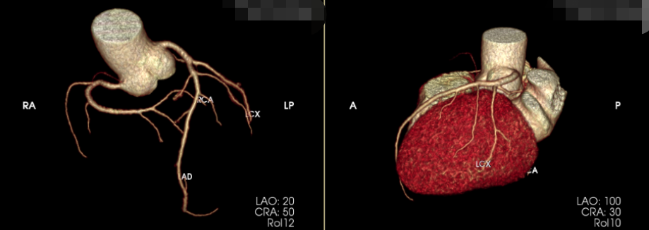 心脏的冠脉是否有斑块等变化,但其准确性仍不足以和冠脉ct,冠脉造影相