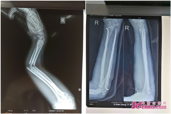 菏泽开发区中心医院:儿童骨折别大意 及时就医正确处理