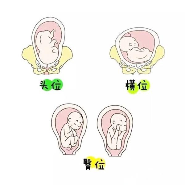 当胎儿横位或臀位的时候,如果胎儿发动分娩了,就可能会卡在产道里,这