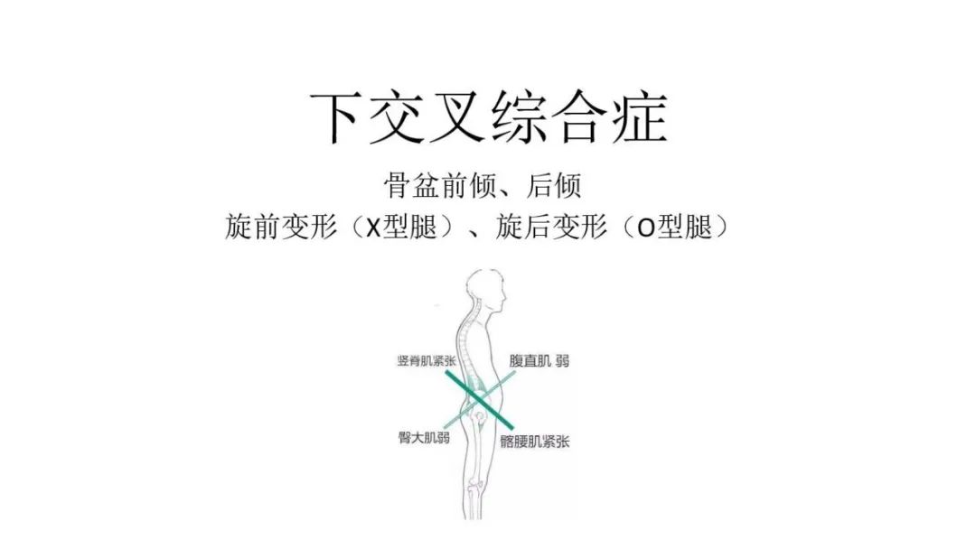 如何自测骨盆前倾