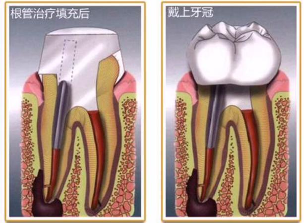 根管治疗后牙冠材质怎么选医生vs患者各执一词