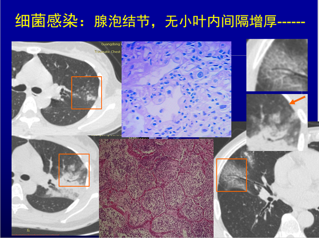 赵振军:最全图文解读《新冠肺炎ct早期诊断和鉴别诊断