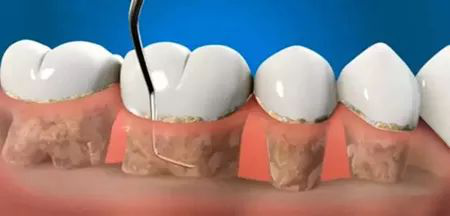 当机体抵抗力降低,牙周袋渗液引流不畅时,可形成牙周脓肿.
