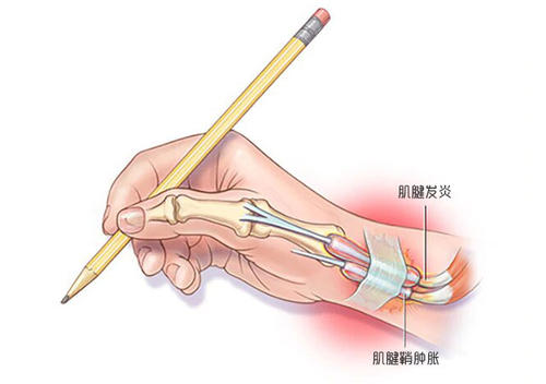 手腕肌腱炎治疗方法 手腕腱鞘炎最好的治疗方法__凤凰网