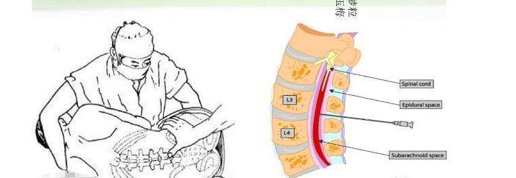 ps:腰椎穿刺的术后并发症主要是低颅压性头痛,表现为坐起后有明显头痛