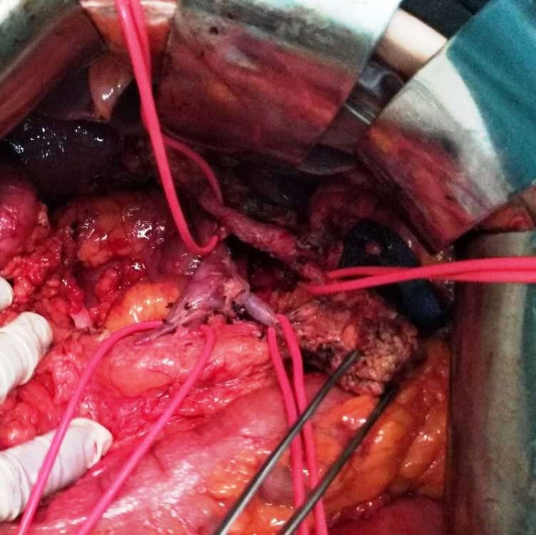 胰腺癌局部晚期,高难外科手术挽救患者生命