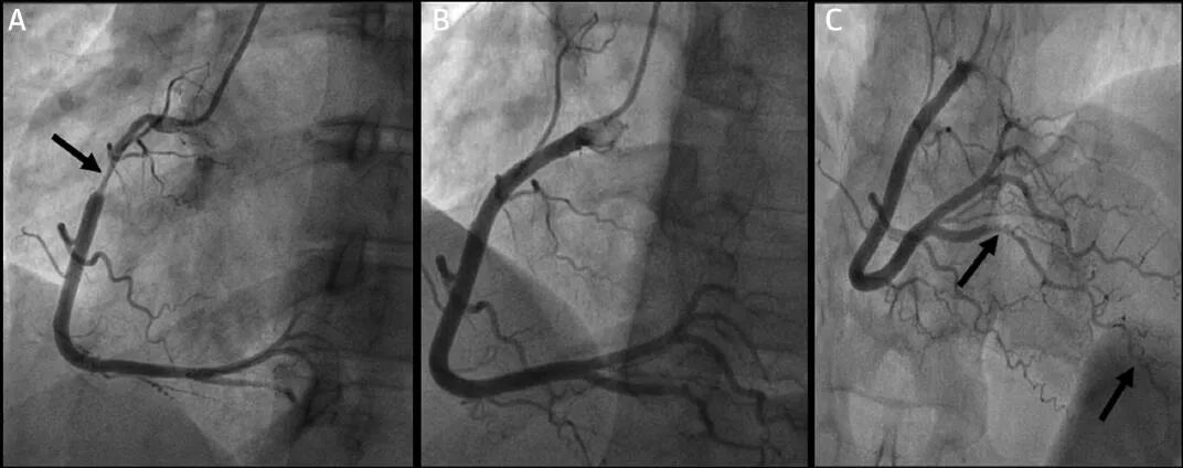 图3至图10所示的冠脉造影示例,即使是最有经验的术者也可能面临挑战.