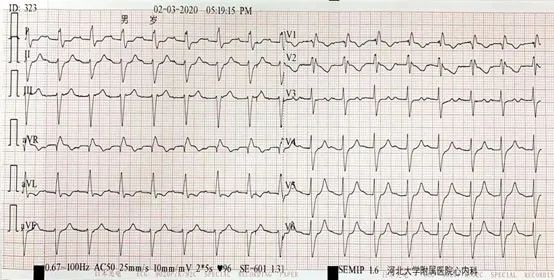 病例丨"一波三折"的三度房室传导阻滞,原因何在?