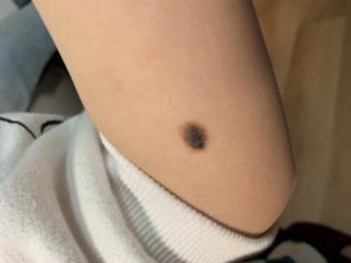 女,50岁,黑痣在脚底板黄豆般大小,手摸略有触感,表面光滑,无痛感,比