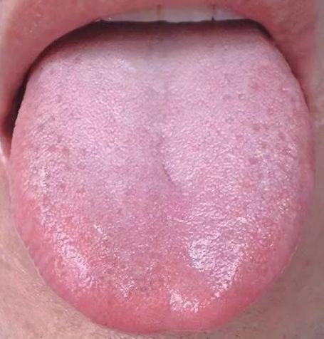 善德集团舌苔发黑舌头发裂或是大病征兆现在知道还不晚