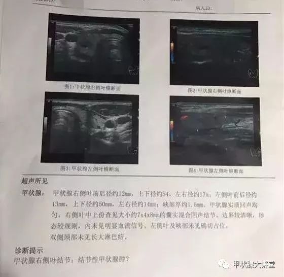 甲状腺峡部结节 凤凰网