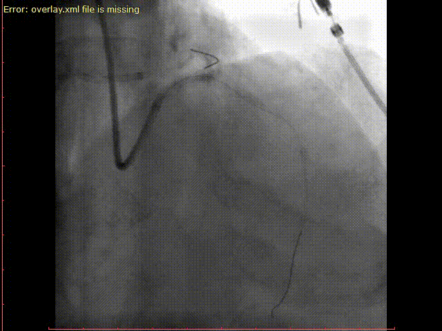 图15-2. 用3.0*12mm nc球囊以12~20个大气压扩张前降支支架,用4.