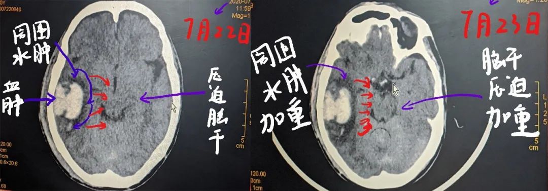 父亲被摩托撞得脑出血却没有肇事者酒驾直接证据