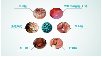 性的不同,hpv分为高危型hpv和低危型hpv  高危型hpv可导致宫颈,肛门