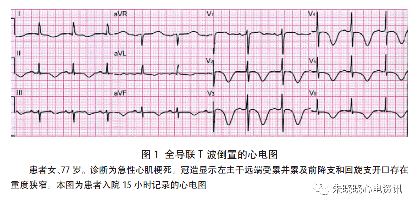 报道的一组100例全导联t波倒置患者中,28例经临床证实为急性心肌梗死