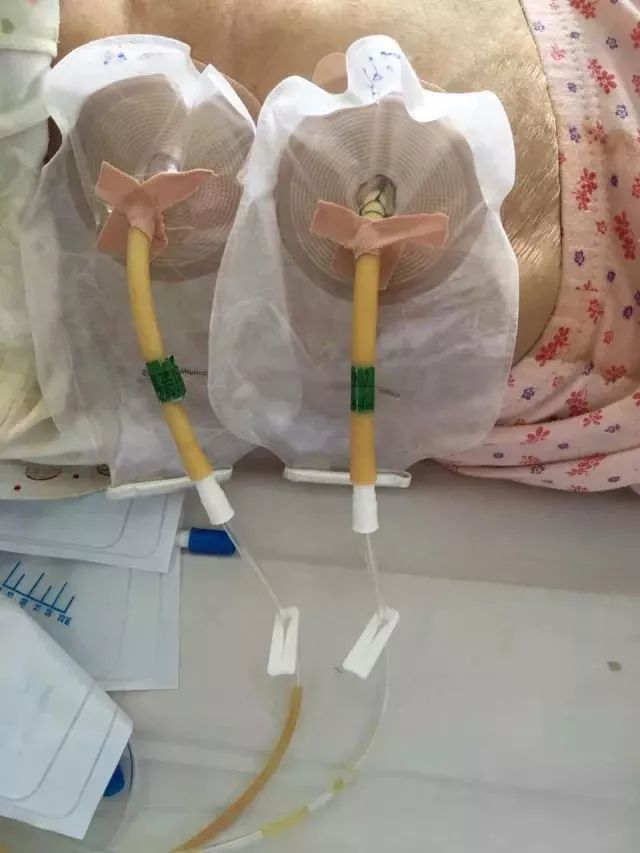 注意上处十字形裁剪尽可能剪小不剪大,造口袋粘贴方向与引流管引流