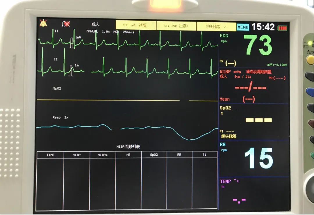 确保患者心电图p波明显(一定要p波正常病人,房颤,看不到
