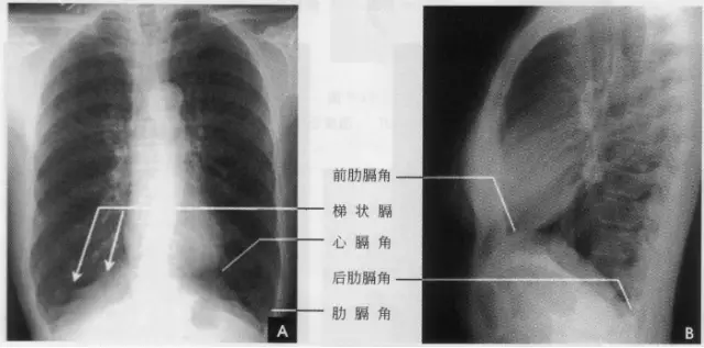 ②波浪瞒:在深吸气时膈面呈3～4个小弧形隆起影,边缘部相互重叠.