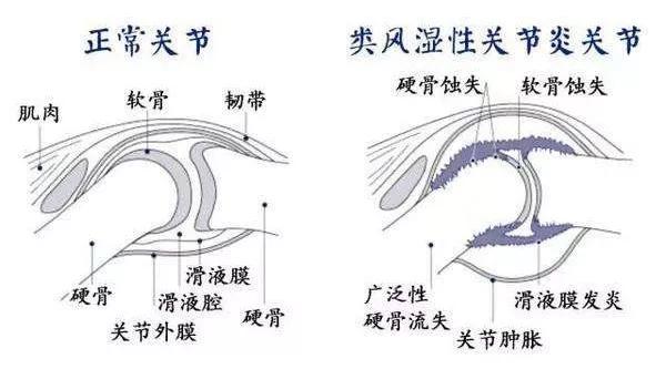 类风湿关节炎的基本病理改变为「血管翳」和「滑膜炎」,通俗地讲,就是