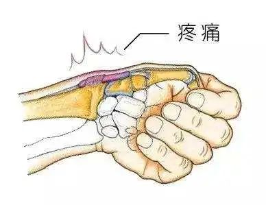 手腕部位按压产生疼痛,或者可以触摸到硬结节.