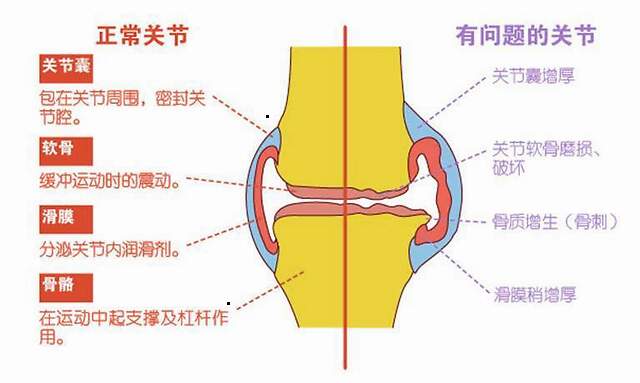 什么是膝关节骨性关节炎?怎么判断是不是得了膝盖的骨