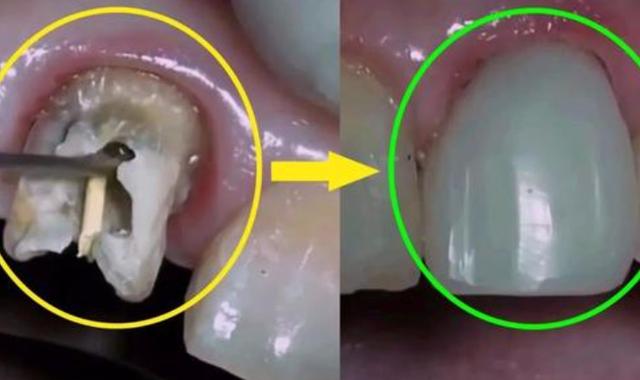 怎么判断蛀牙是否烂到牙神经了?烂到神经还能补牙吗?