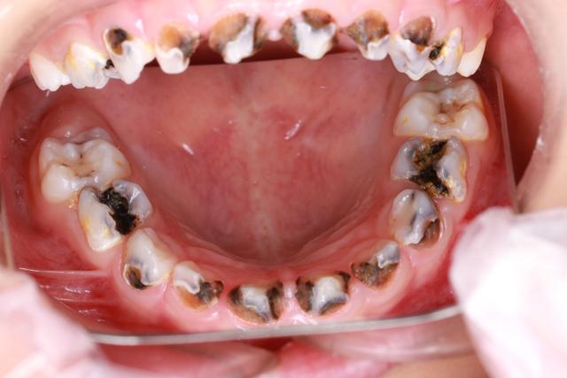 王雨新检查了晨晨的牙齿,发现晨晨的 20颗乳牙不同程度龋坏,伴有牙髓