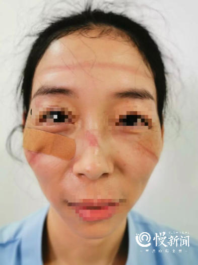 如症状轻微仅有轻度压痕者可不做特殊处理,若压痕持续存在或伴有皮下