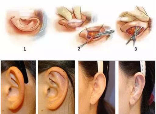 招风耳手术矫正是如何做的?