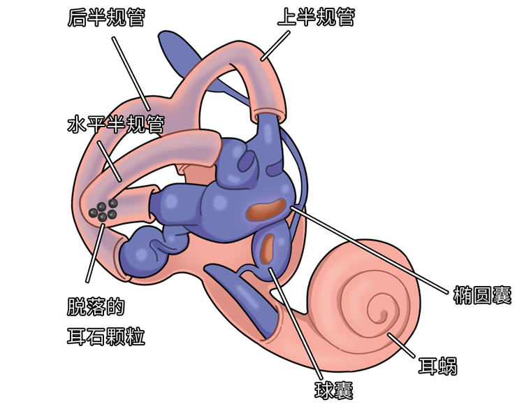 进入半规管的可能性有出现耳石脱落当头部受外伤后头部受外伤都会导致
