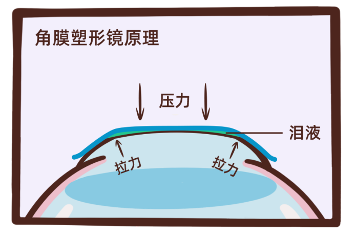 睡觉就能治近视的角膜塑形镜到底靠不靠谱