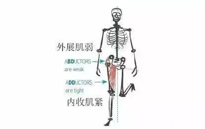 外展肌弱,走路时骨盆无法保持水平线 如图,左腿