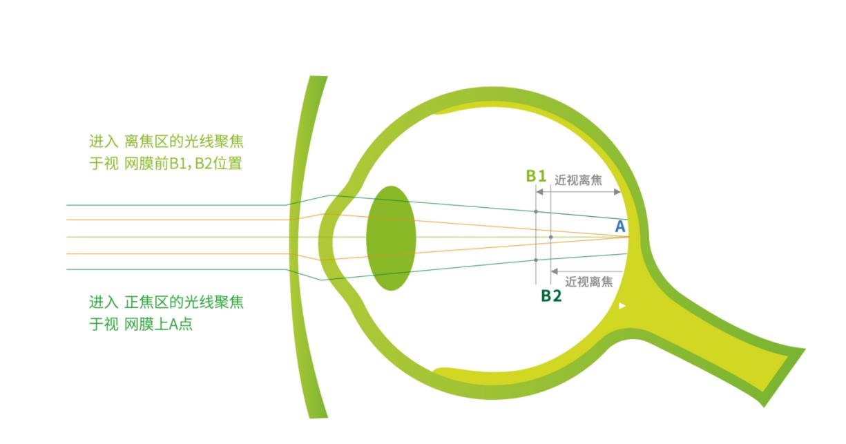 星乐视s.cma多点复合离焦镜片延缓近视发展原理图