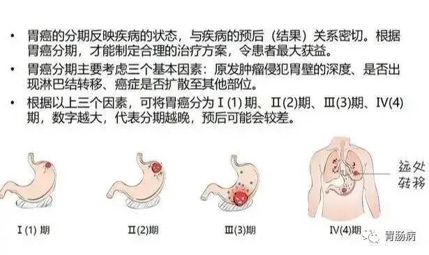 tvb老戏骨因胃癌去世:这6类人一定要注意!尤其是男性