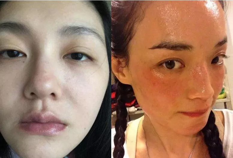 色素沉着及毛细血管扩张中度老化:松弛性眼袋,静态鱼尾纹,中面部欠