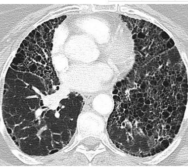 对话李惠萍:不可逆肺纤维化患者如何延长寿命?工具多了一种