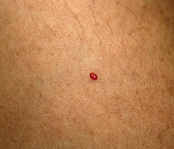 蜘蛛痣的中心为 红点痣,围绕着中心点有 许多小血管呈放射状分布,这种