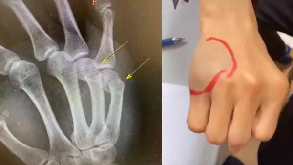上海男子掌骨骨折夜看急诊:看孩子写作业,生气一拳锤到墙上