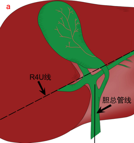 尤其是在肝Ⅳ发育不全和异位胆囊时,可以降低意外胆管损伤的风险