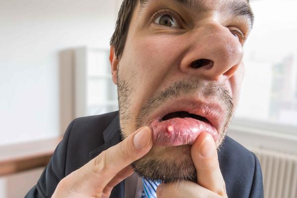 口腔癌来临身体会有5种异常及时检查避免错过治疗时期