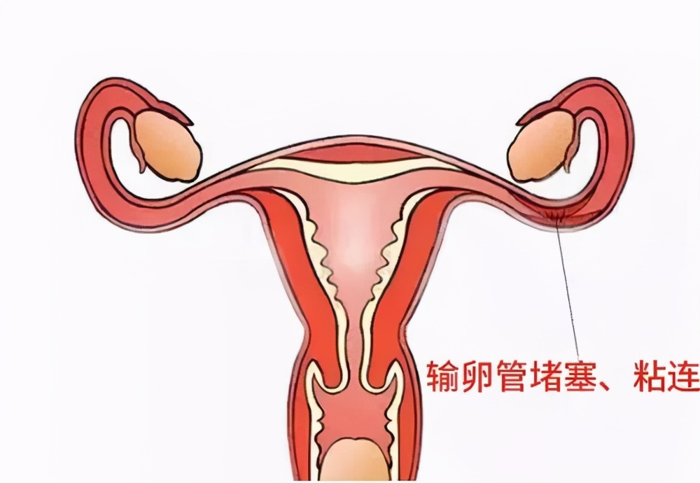 输卵管堵塞与输粘连有什么不同?__凤凰网