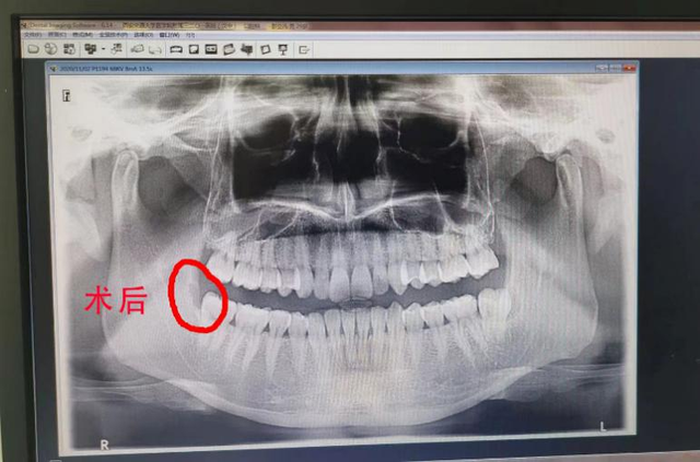 市民看牙被误诊智齿致牙髓坏死,汉中市口腔医院迟迟不