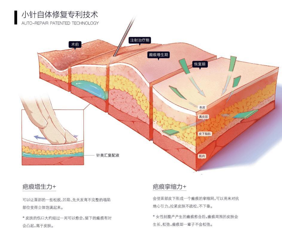 财经>商讯>正文> 同时,欧邦针美汇独创的"小针自体修复技术"更是倡导