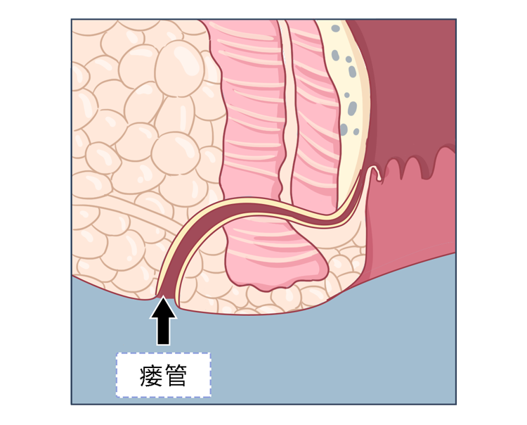 大量细菌导致粪便长期堆积在肛隐窝一般是排泄后没擦干净而肛瘘的形